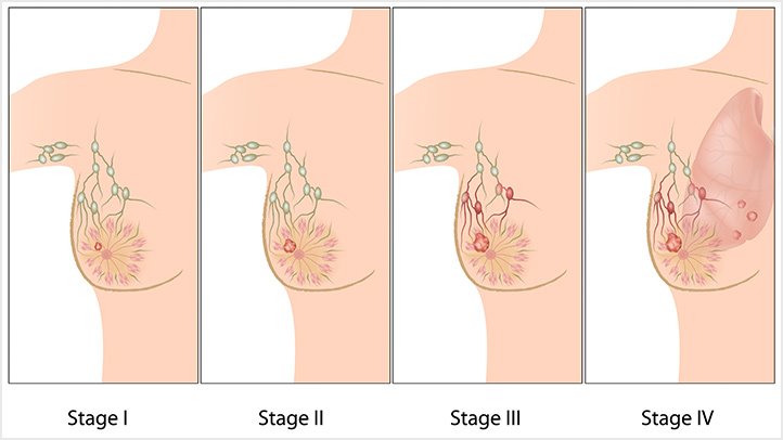breast implants cancer