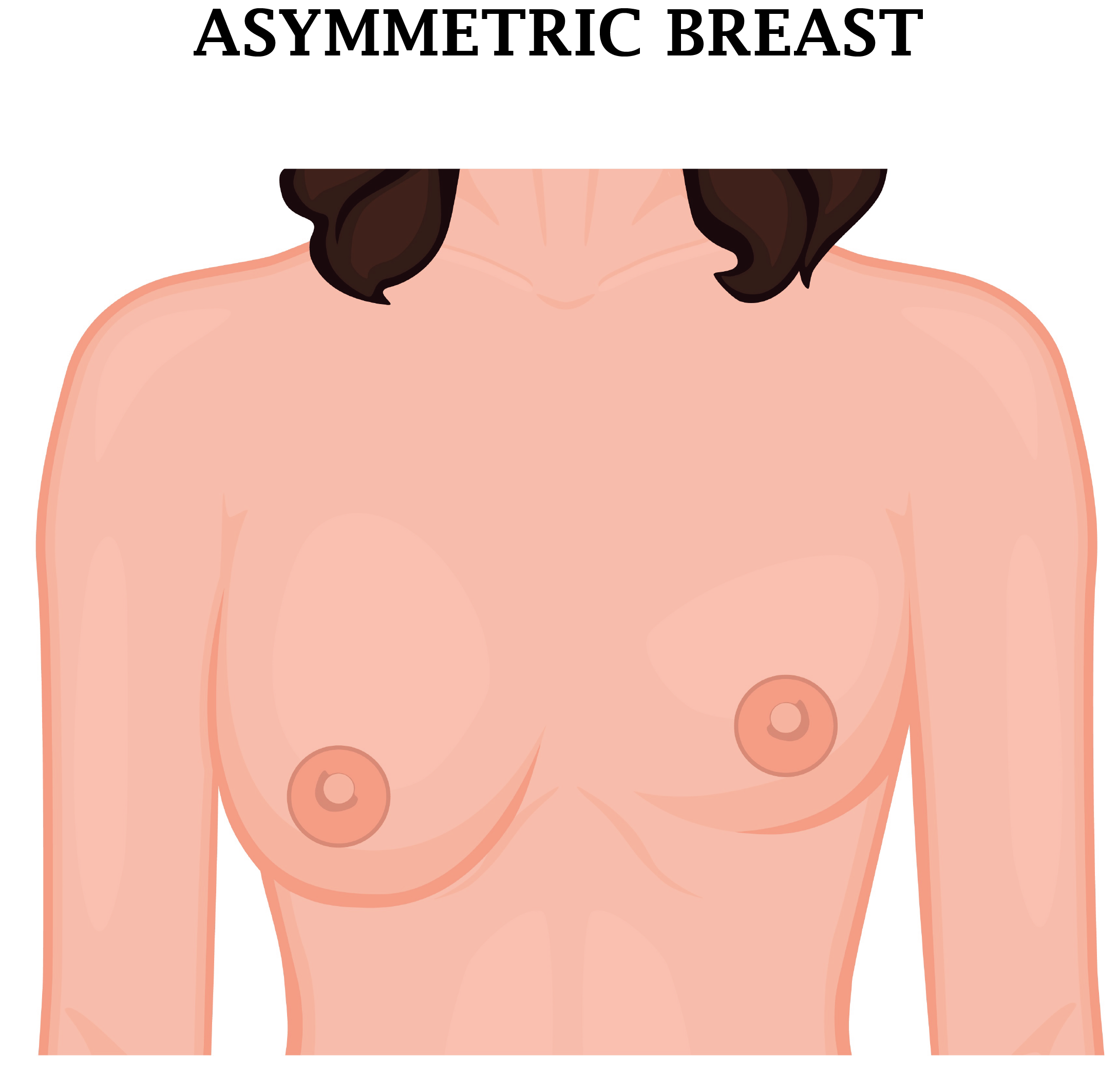 breast asymmetry