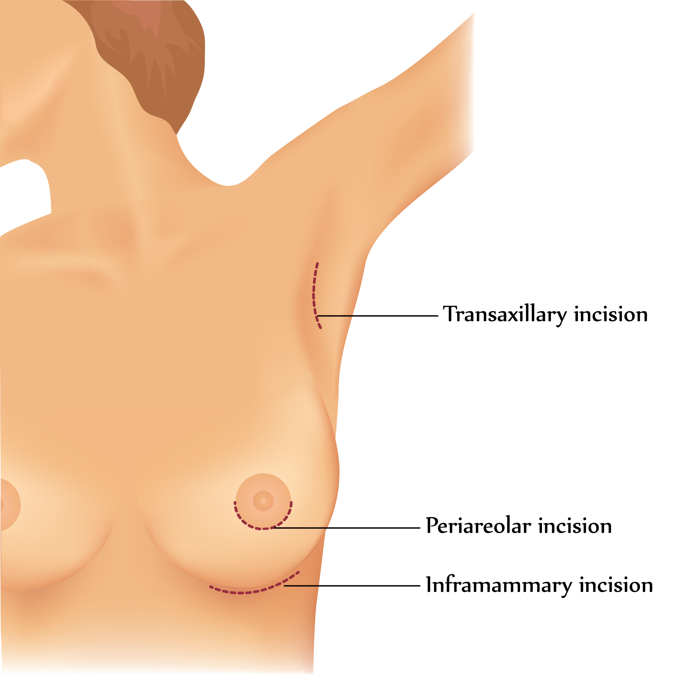 breast augmentation incisions