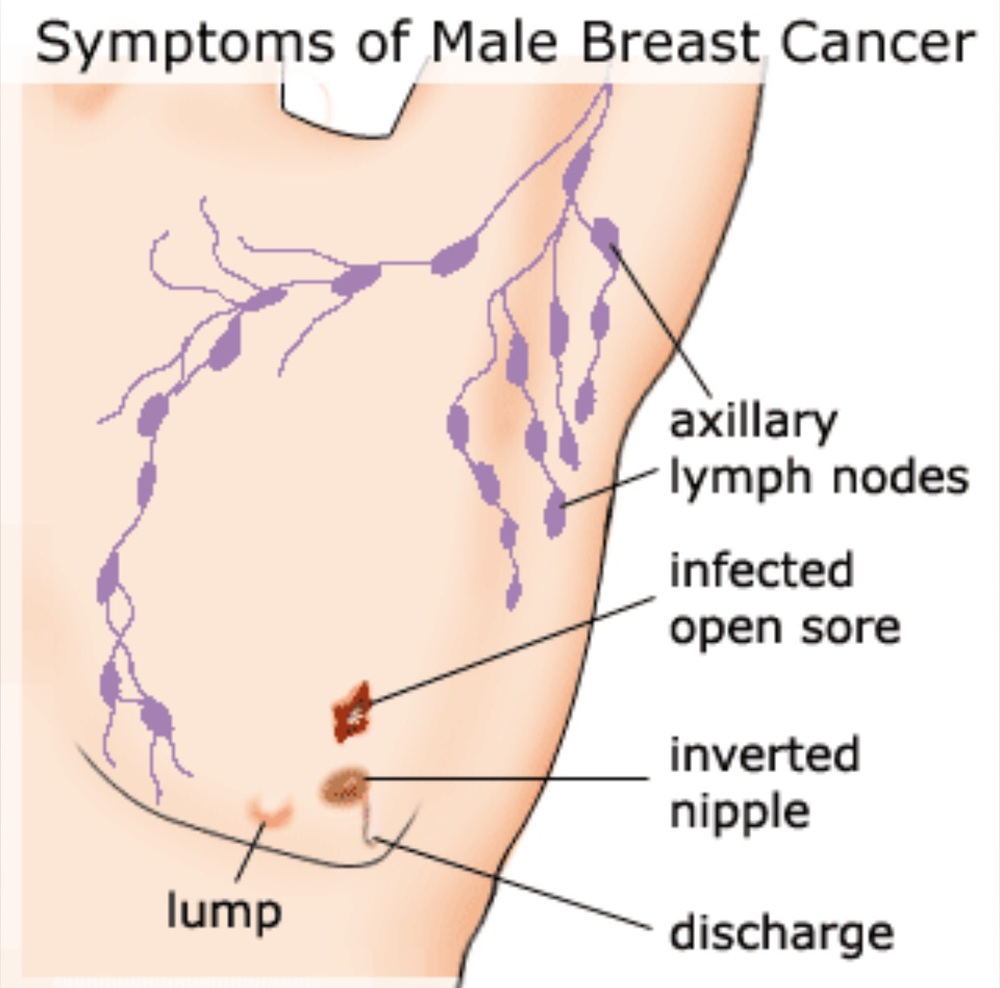 symptoms of breast cancer in men