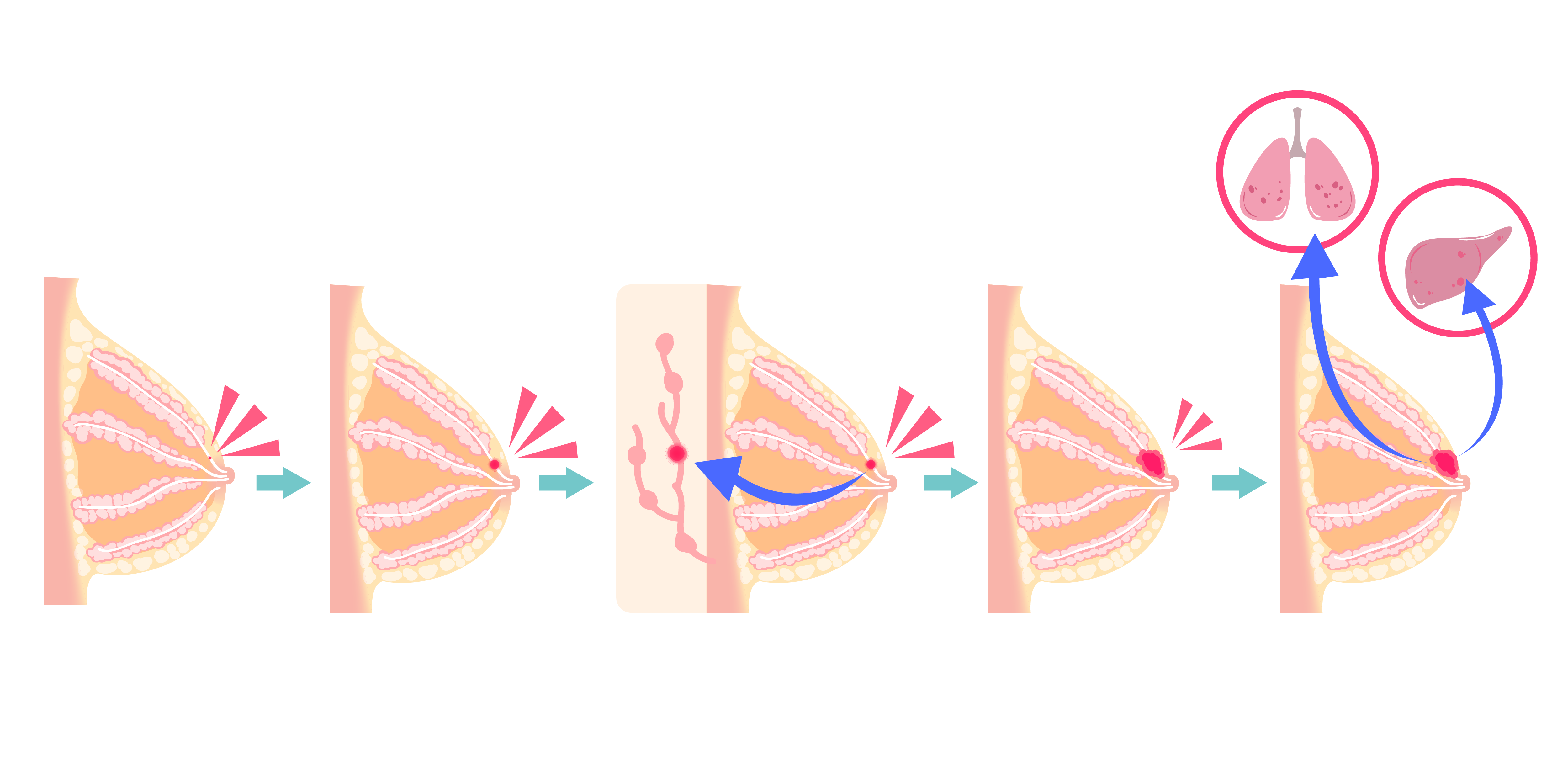 breast cancer stages