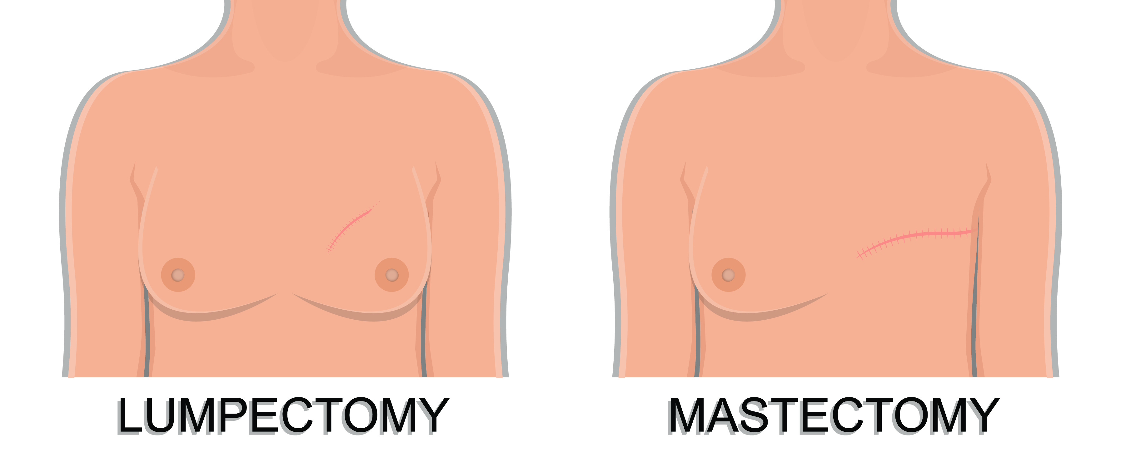 breast cancer treatments