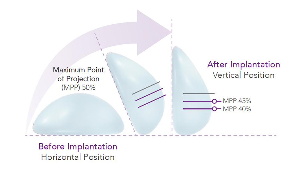 Motiva Ergonomix® More Than Just Natural-looking Breasts