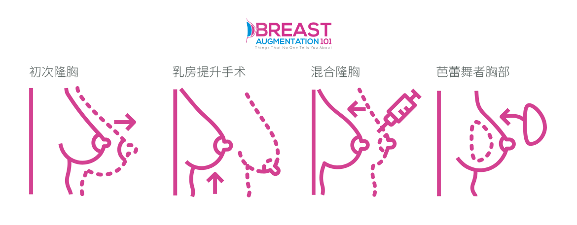 BA101 CN breast infographic