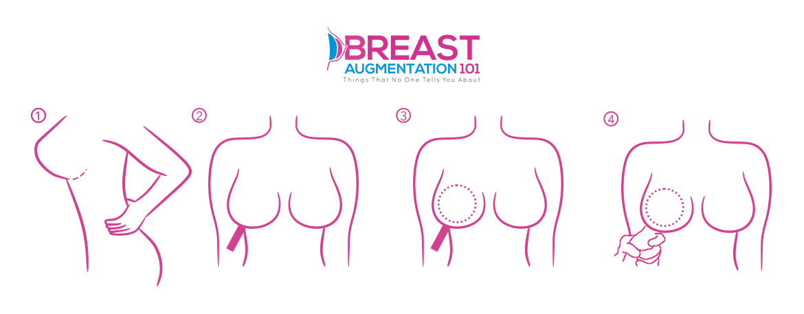 Preserve Breast Tissue Preservation